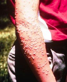 Stings from Red Imported Fire Ants